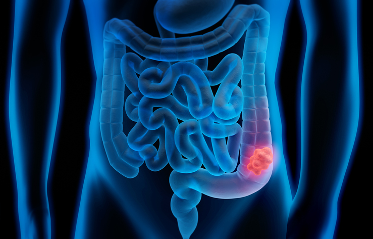 cáncer de colon
