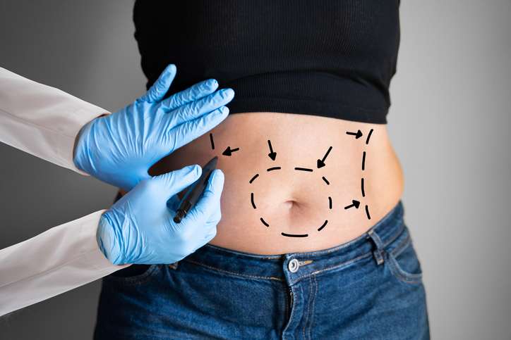 tummy tuck liposucción qué son