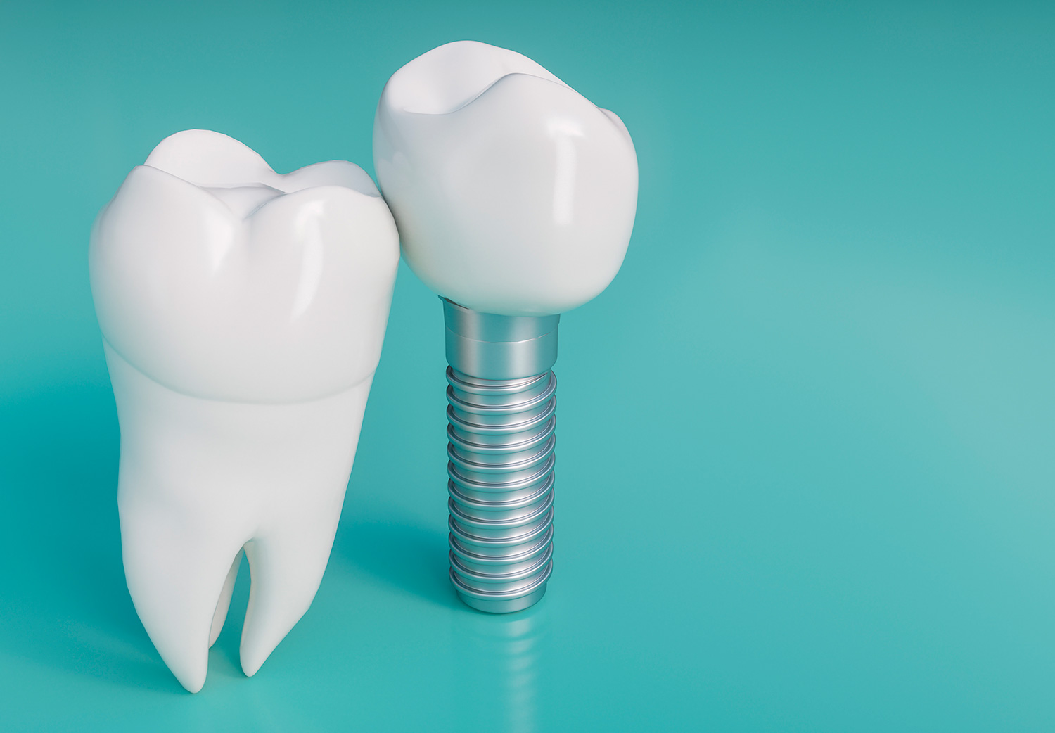 implantes dentales Alejandro asz